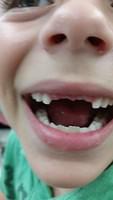 Missing 2 Front Teeth